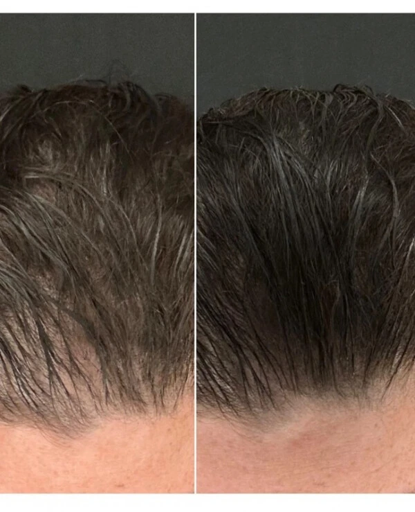 Calecim Professional Система восстановления волос | Advanced Hair System – Система восстановления волос с экзосомами
